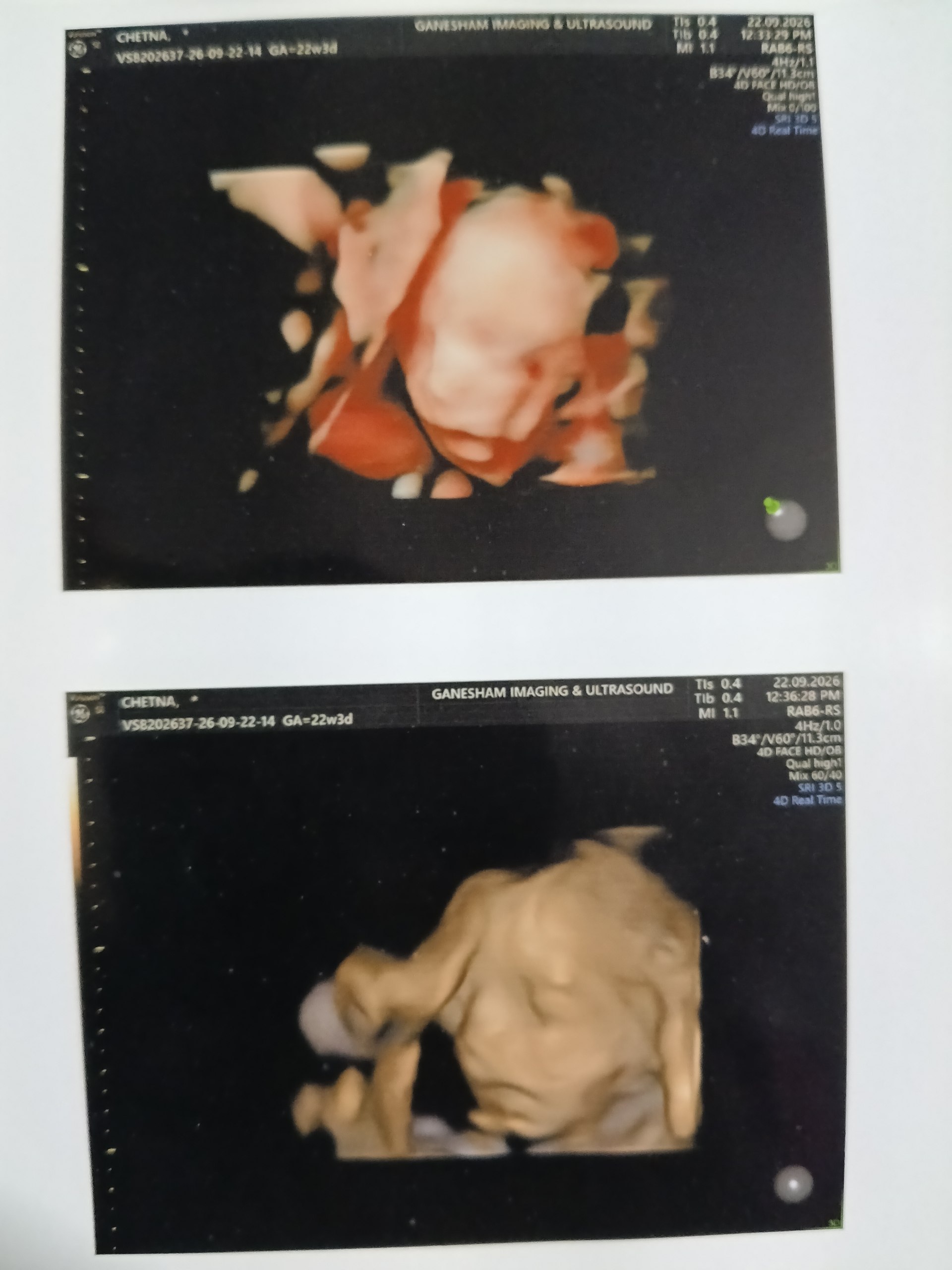 Baby 3D Ultrasound Scan